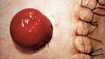 Post-OP Bild eines Stomas mit Operationsnarbe