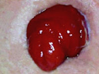 Stoma