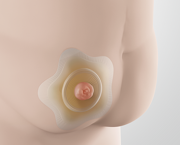 SenSura® Mio konkav - für Rundungen <br\>wie Bauchrollen oder Hernien
